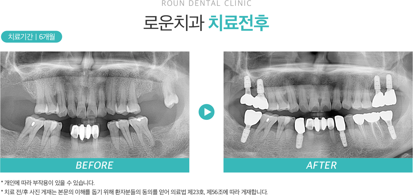 로운치과 치료전후