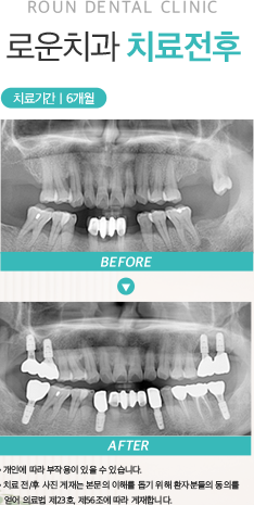 로운치과 치료전후